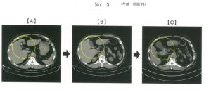 107回看護師試験午前問題70